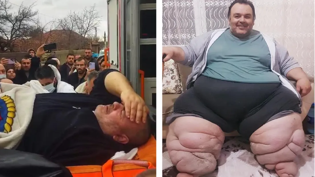 Engin Akbadal'ın Fil Hastalığı İçin Ankara'ya Sevk Edilmesi