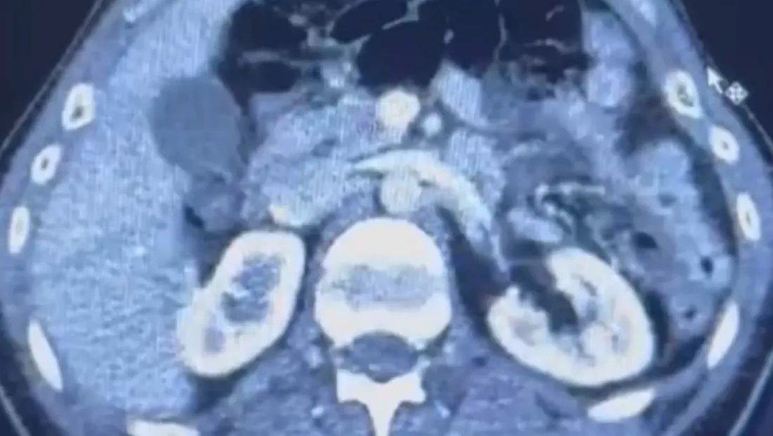 Ülkesinden kaçan İranlı midesinde 50 kapsül uyuşturucu ile yakalandı