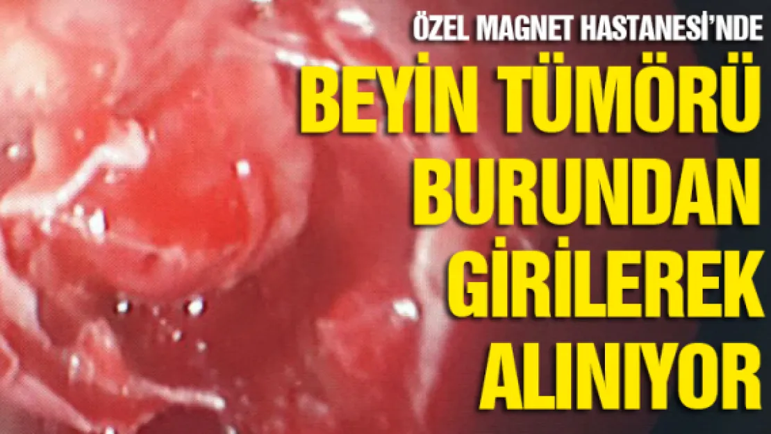 Beyin tümörü burundan girilerek alınıyor