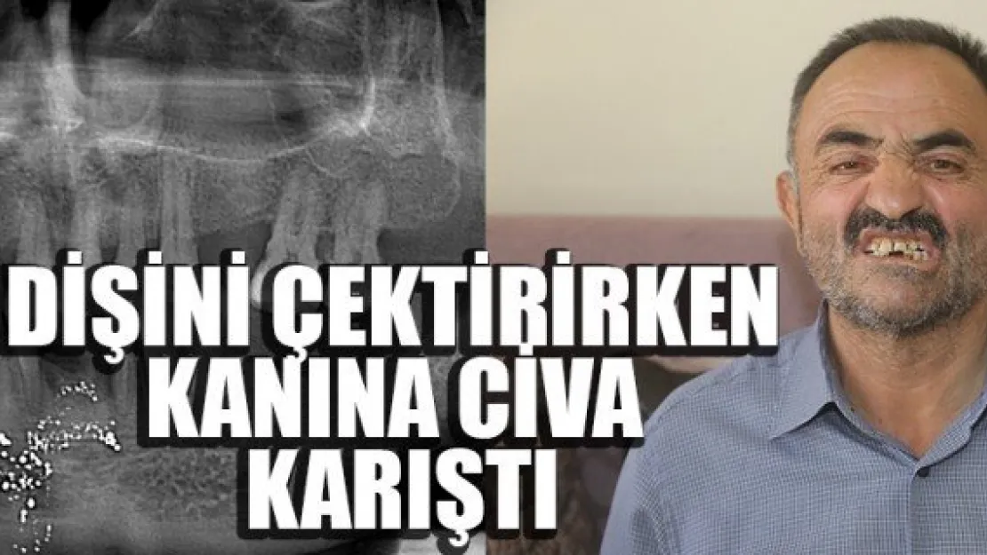 DİŞİNİ ÇEKTİRİRKEN KANINA CİVA KARIŞTI