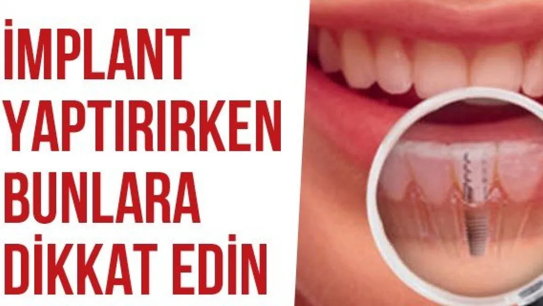 İmplant Yaptırırken Bunlara Dikkat Edin