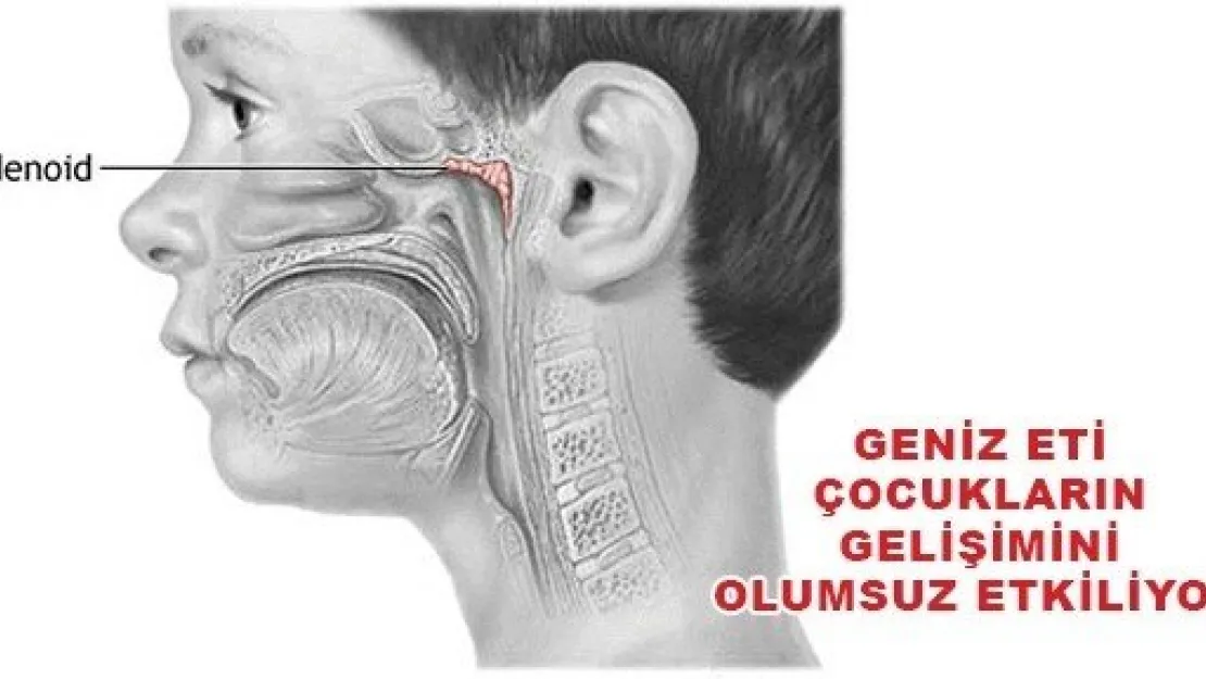  GENİZ ETİ ÇOCUKLARIN GELİŞİMİNİ OLUMSUZ ETKİLİYOR