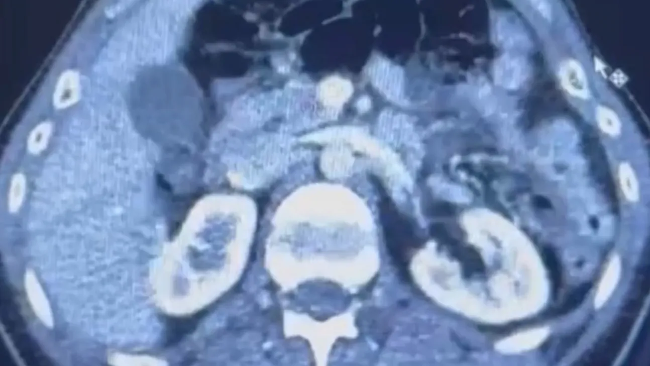 Ülkesinden kaçan İranlı midesinde 50 kapsül uyuşturucu ile yakalandı