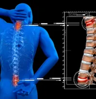 Omurga kırığında yeni nesil tedavi nasıl uygulanır?