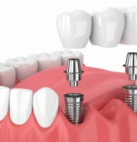 Ucuz İmplantın gelecekteki handikapları