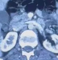 Ülkesinden kaçan İranlı midesinde 50 kapsül uyuşturucu ile yakalandı