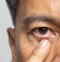 Uzmanlardan uyarı: Göz kuruluğu göz sağlığını tehdit ediyor