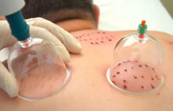 Doktor Kılınç, 'Hacamatın özel günü yok!'