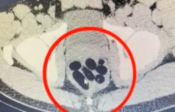 Kayseri'de kadının midesinden yarım kilo uyuşturucu kapsül çıkarıldı