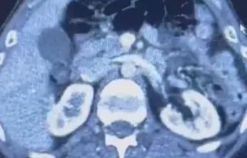 Ülkesinden kaçan İranlı midesinde 50 kapsül uyuşturucu ile yakalandı