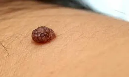 Benlerinizi Lazer veya Asitle Aldırmayın! Uzmanı tek güvenli yöntemi açıklıyor
