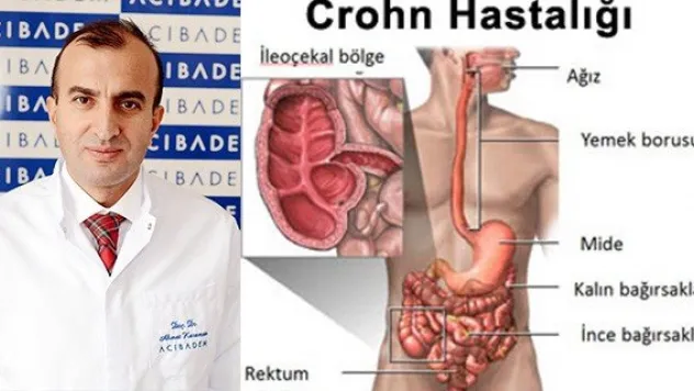 'Crohn hastalığı' bağırsak sağlığını bozuyor
