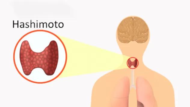 YAVAŞLATAN JAPON: HASHIMOTO TİROİDİ