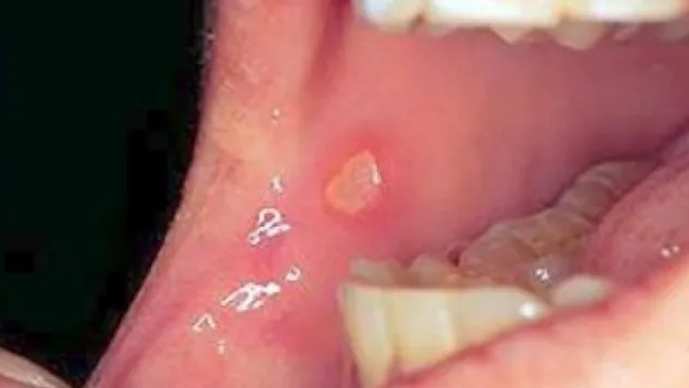Ağzınızda çok sık aft oluşuyorsa 4 uyarıya dikkat