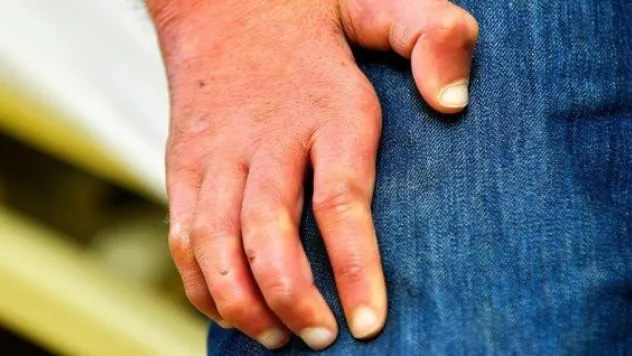 Türkiye'de cüzzam azalıyor