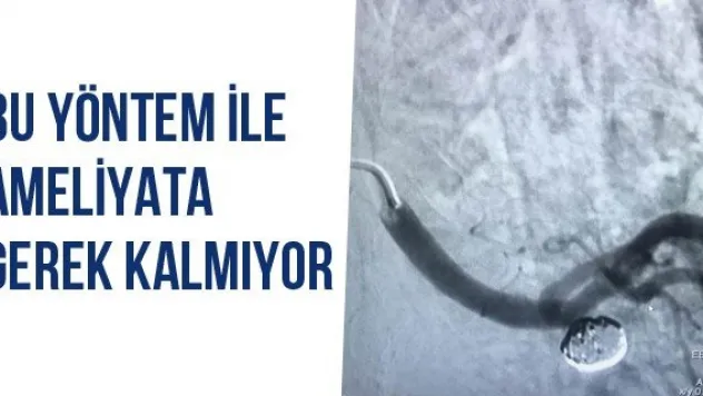 Bu Yöntem İle Ameliyata Gerek Kalmıyor