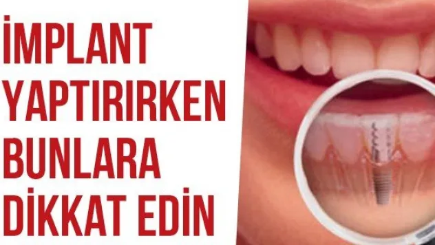 İmplant Yaptırırken Bunlara Dikkat Edin