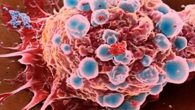 Kadınlar 50 Yaşından Sonra Kanser Riski Altında