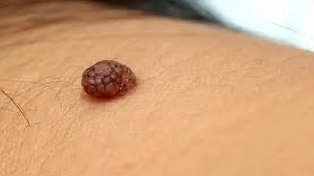 Benlerinizi Lazer veya Asitle Aldırmayın! Uzmanı tek güvenli yöntemi açıklıyor