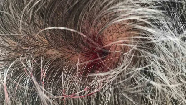 Ceviz büyüklüğündeki dolu vatandaşın kafasını yardı