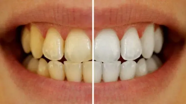 'Diş beyazlatma uzman kontrolünde yapılmalı'