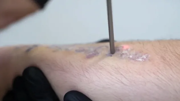 Dövme sildirmek, yaptırmaktan riskli