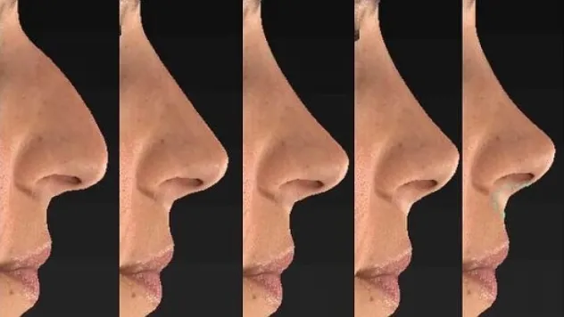 En çok yaptırılan beş estetikten biri ''Burun Estetiği''