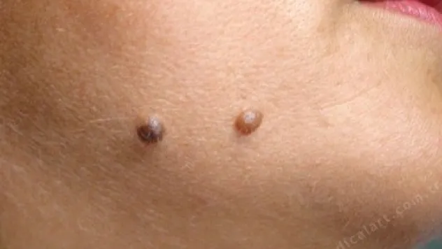 ERÜ'de Ücretsiz Ben Muayenesi Yapılacak