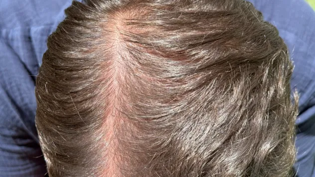 Güneş saç derisini etkiliyor mu?