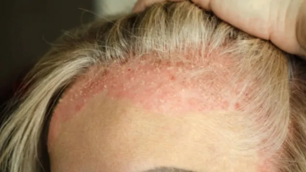 Mevsim geçişlerinde cildin nem dengesi bozulabilir: Egzama belirtileri neler?