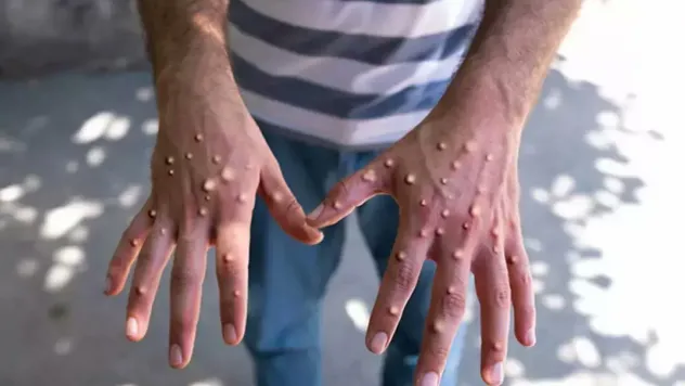 Yeni tehlikeli bir virüsümüz daha oldu