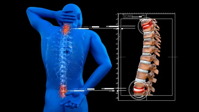 Omurga kırığında yeni nesil tedavi nasıl uygulanır?