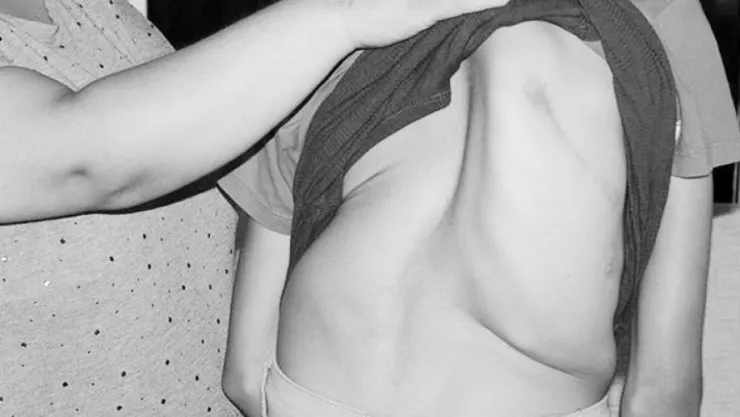 Skolyoz ergenlikte ortaya çıkıyor