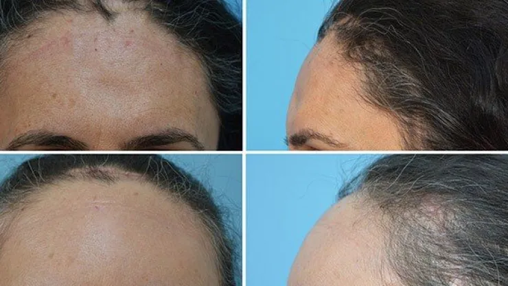 Kayseri'de ilk uygulamayla kafatası düzeltildi