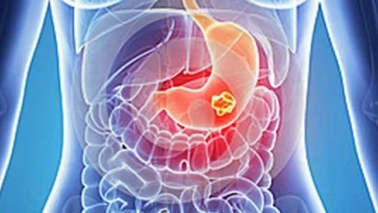 Mide kanserinde korkutan rakamlar