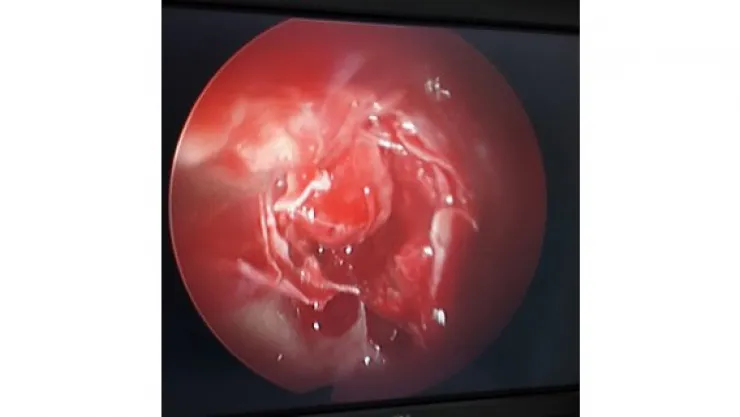 Beyin tümörü burundan girilerek alınıyor