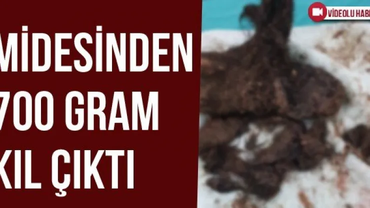 Midesinden 700 Gram Kıl Çıktı
