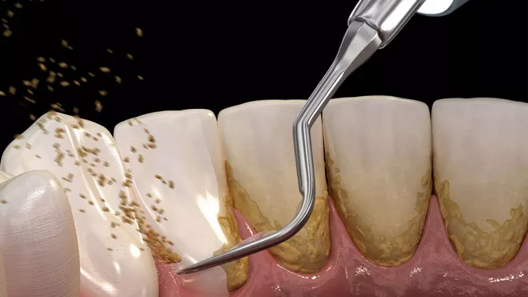 Diş taşı temizliği dişlere zarar verir mi?