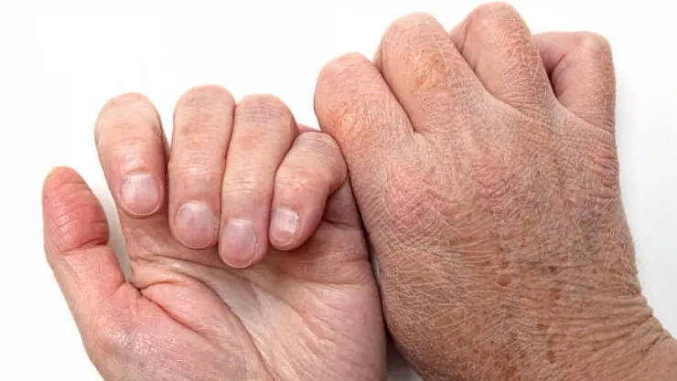 Uzmanlardan eller ve dudaklar için kış uyarısı: Bol su ve krem
