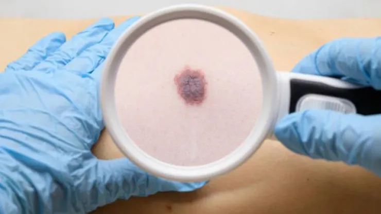 Zararlı güneş ışınları kansere sebep olabilir