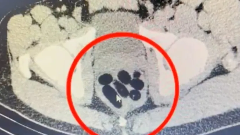 Kayseri'de kadının midesinden yarım kilo uyuşturucu kapsül çıkarıldı