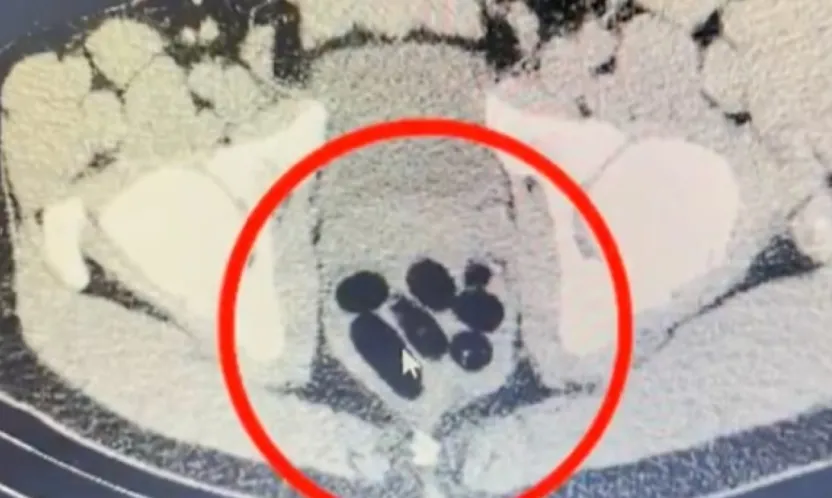 Kayseri'de kadının midesinden yarım kilo uyuşturucu kapsül çıkarıldı